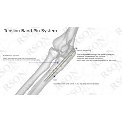 Tension Band Pin System 